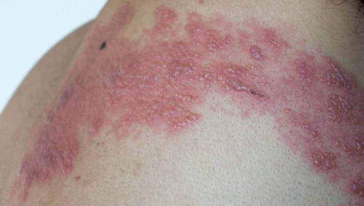 what is Shingles? Causes, Symptoms, and Treatments